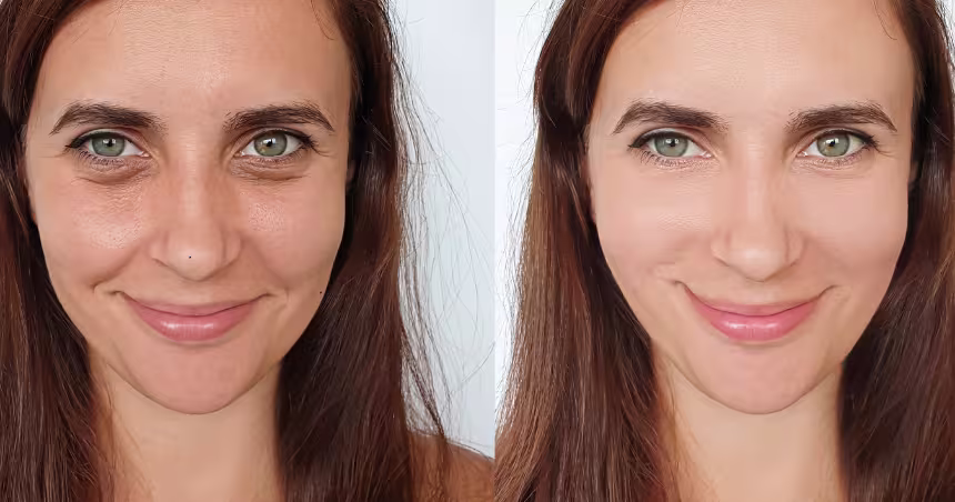Antes y después de tratamiento con toxina botulínica en frente y entrecejo
