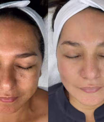 Textura irregular antes del tratamiento Dermaplaning