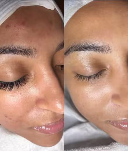 Testimonio de Camila, paciente de Peeling en Bogotá