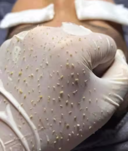 Testimonio de Laura, paciente de limpieza facial medicalizada en Bogotá