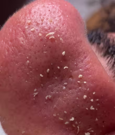 Testimonio de Sofía, paciente de limpieza facial medicalizada en Bogotá