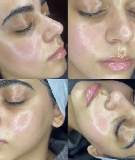 Testimonio de Valentina, paciente de Dermaplaning en Bogotá