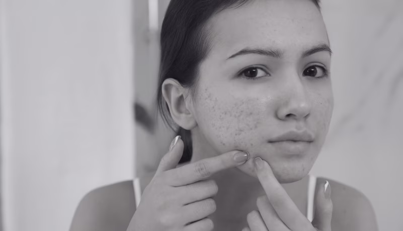 Paciente recibiendo limpieza facial medicalizada para acné en Bogotá